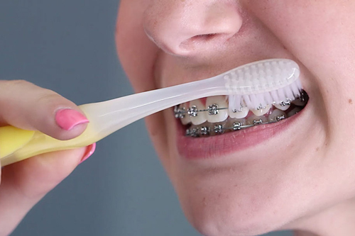 Oral Hygiene For The Orthodontic&nbsp;Patient