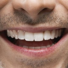 Teeth after braces with good oral hygiene. Picture courtesy of Maximum Living.