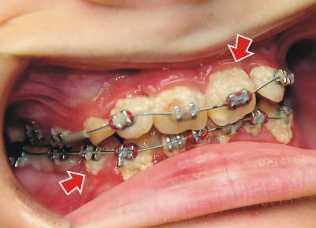 Plaque built up on a patients teeth and braces. picture courtesy of Askaorthodontist.com.