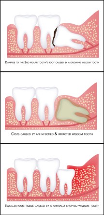 reasons_to_have_your_wisdom_teeth_removed